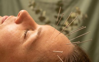 Is acupunctuur geschikt voor migraine behandeling?